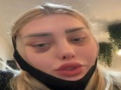 انفجار رأس فتاة أثناء رحلة جوية