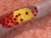 تصلب الشرايين.. 8 أسباب تزيد احتمالات الإصابة