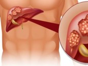 علماء يبتكرون أسلوباً لاكتشاف سرطان الكبد من خلال قطرة دَم واحدة
