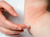 ما سبب ظهور البقع الحمراء على الجسم؟