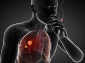 استشاري: التدخين المسبب الأول للسرطان بنسبة 33%