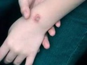 عدوى بكتيرية تحدث هلعاً في بريطانيا