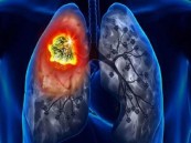 “الغذاء والدواء الأمريكية” توافق على عقار جديد مضاد لسرطان الرئة