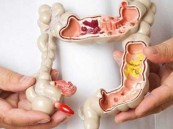 مشروبات شائعة يفضلها الكثيرون قد تضاعف خطر الإصابة بسرطان الأمعاء