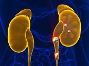 الإفراط في تناول هذا الفيتامين قد يسبب تكون حصى الكلى