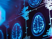 أمريكا تجيز دواءً جديداً لعلاج مرضى الزهايمر