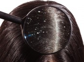 أنواع قشرة الشعر وكيفية الوقاية منها