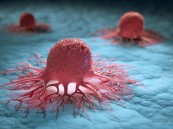 “معرفتك بها ستنقذك”.. أشهر 5 علامات للإصابة بأخطر أنواع السرطانات