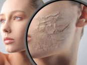 استشاري الجلد يحذر من الخلطات المنتشرة.. ويؤكد: “ثلث راتب الأب يذهب لجمال الزوجة”