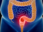 في الأحساء.. “مسار سرطان القولون” تكتشف مبكرًا سرطان القولون لمريض يبلغ من العمر 55 عاما