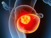 أسباب الإصابة بسرطان المثانة.. وأبرز طرق الوقاية
