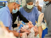 بمشاركة 35 من الاستشاريين.. البدء في فصل التوأم السيامي النيجيري