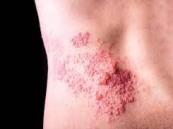 عدوى فيروسية تثير القلق والمخاوف بين المواطنين.. وطبيب أسرة يوضح