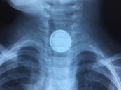 إنقاذ حياة طفل ابتلع بطارية و14 قطعة لأجسام مختلفة