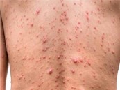 احذروا جدري القرود.. تصريحات صادمة من “الصحة العالمية” بشأن تفشي المرض