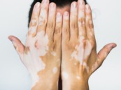 نصائح مهمة من “صحة الشرقية” للمصاب بالبهاق