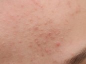 نصائح مهمة من خبيرة أمراض جلدية لتجنب ظهور بثور البشرة في الطقس الحار