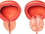 المرض الأول للرجال.. طبيب مسالك يحذّر من تضخم البروستات