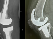 في إنجاز طبي بارز.. مستشفى الحبيب بالخبر يعيد المشي لسبعينية بعملية استبدال مفصل ركبة متطورة