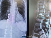 بعد 5 محاولات جراحية لم تنجح.. مستشفى الحبيب بالخبر يُمكّن سبعينية من المشي مجددًا