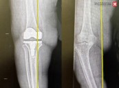 نجاح أول عملية استبدال ركبة بالروبوت الجراحي في مستشفى الدكتور سليمان الحبيب بالخبر