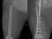 مستشفى الحبيب بالخبر يستبدل مفصلي الركبة والورك وعظمة الفخذ ويعيد “الحركة” لـ”ستينية”