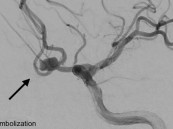 في الأحساء.. نجاح تنفيذ أول إجراء لإغلاق تمدد شرياني دماغي بالقسطرة