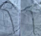 مستشفى الحبيب بالخبر ينقذ حياة مراجع توقف قلبه بسبب انسداد كلي للشريان النازل