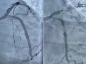 مستشفى الحبيب بالخبر ينقذ حياة مراجع توقف قلبه بسبب انسداد كلي للشريان النازل