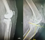 مستشفى الحبيب بالخبر يُجري عملية زراعة مفصل معقدة لإعادة قدرة المشي لثمانينية