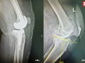 مستشفى الحبيب بالخبر يُجري عملية زراعة مفصل معقدة لإعادة قدرة المشي لثمانينية