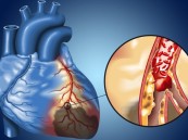 بين الدواء والقسطرة.. استشاري أمراض قلب يشرح الحقائق الطبية عن تضيق الشرايين