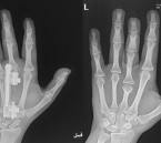 جراحة ميكروسكوبية دقيقة تُنهي معاناة عشرينية من تشوه خلقي باليدين في مستشفى الحبيب بالخبر