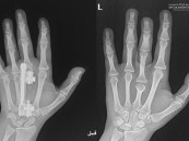 جراحة ميكروسكوبية دقيقة تُنهي معاناة عشرينية من تشوه خلقي باليدين في مستشفى الحبيب بالخبر