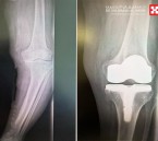 استبدال مفصل الركبة يُنهي معاناة مسن بمستشفى الحبيب في الخبر