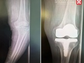 استبدال مفصل الركبة يُنهي معاناة مسن بمستشفى الحبيب في الخبر
