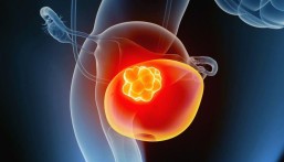 أسباب الإصابة بسرطان المثانة.. وأبرز طرق الوقاية