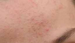 نصائح مهمة من خبيرة أمراض جلدية لتجنب ظهور بثور البشرة في الطقس الحار