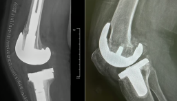 في إنجاز طبي بارز.. مستشفى الحبيب بالخبر يعيد المشي لسبعينية بعملية استبدال مفصل ركبة متطورة