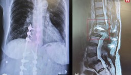 بعد 5 محاولات جراحية لم تنجح.. مستشفى الحبيب بالخبر يُمكّن سبعينية من المشي مجددًا
