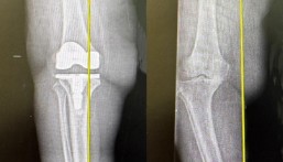 نجاح أول عملية استبدال ركبة بالروبوت الجراحي في مستشفى الدكتور سليمان الحبيب بالخبر