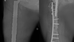 مستشفى الحبيب بالخبر يستبدل مفصلي الركبة والورك وعظمة الفخذ ويعيد “الحركة” لـ”ستينية”