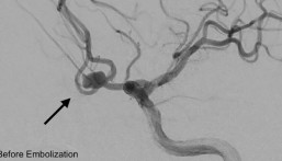 في الأحساء.. نجاح تنفيذ أول إجراء لإغلاق تمدد شرياني دماغي بالقسطرة