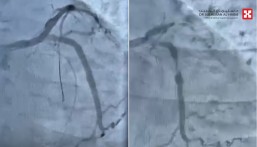 مستشفى الحبيب بالخبر ينقذ حياة مراجع توقف قلبه بسبب انسداد كلي للشريان النازل
