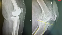 مستشفى الحبيب بالخبر يُجري عملية زراعة مفصل معقدة لإعادة قدرة المشي لثمانينية
