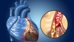 بين الدواء والقسطرة.. استشاري أمراض قلب يشرح الحقائق الطبية عن تضيق الشرايين
