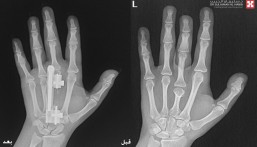 جراحة ميكروسكوبية دقيقة تُنهي معاناة عشرينية من تشوه خلقي باليدين في مستشفى الحبيب بالخبر