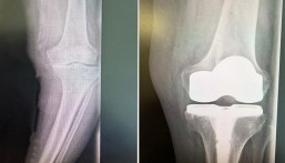 استبدال مفصل الركبة يُنهي معاناة مسن بمستشفى الحبيب في الخبر