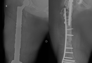 مستشفى الحبيب بالخبر يستبدل مفصلي الركبة والورك وعظمة الفخذ ويعيد “الحركة” لـ”ستينية”