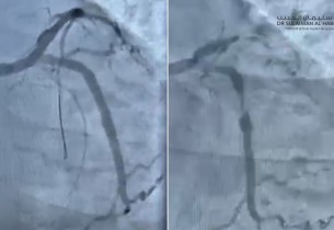 مستشفى الحبيب بالخبر ينقذ حياة مراجع توقف قلبه بسبب انسداد كلي للشريان النازل